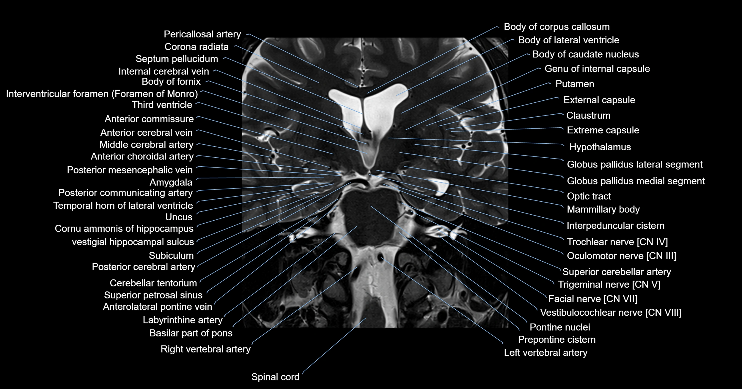 MRI brainstem & basal ganglia anatomy labelled 3T MRI images -img-00001-00018.webp